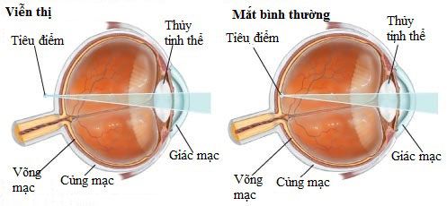 phau-thuat-lasik