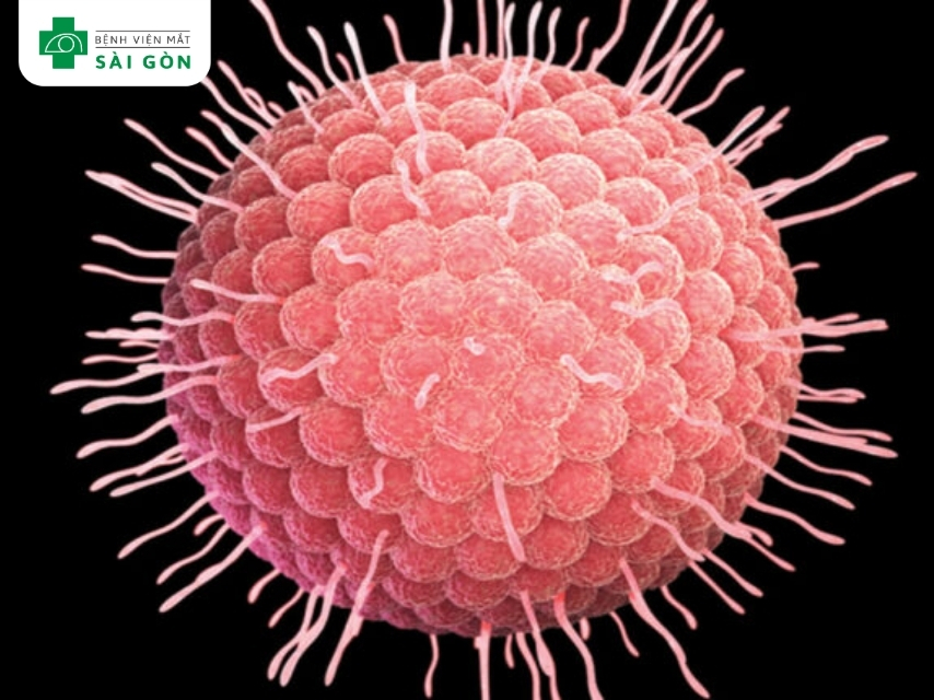 Zona thần kinh mắt do VZV