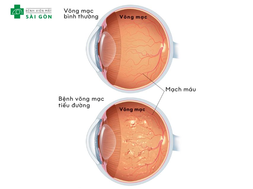 Bệnh võng mạc tiểu đường