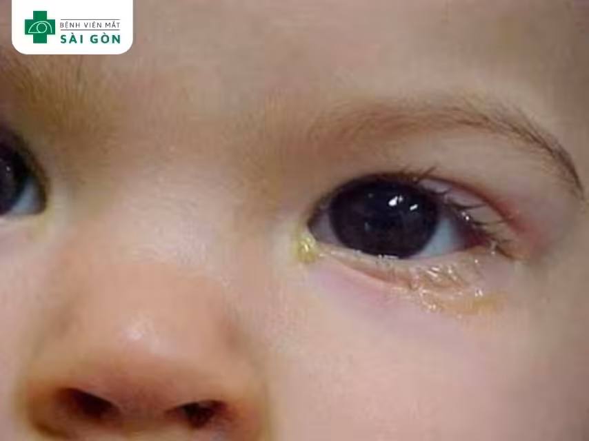 Xử lý khi mắt bé đổ ghèn