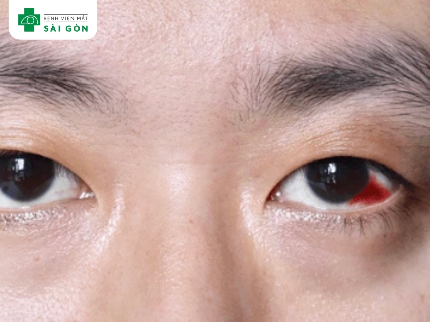 Mạch máu nhỏ trong lòng trắng vỡ gây xuất huyết dưới kết mạc