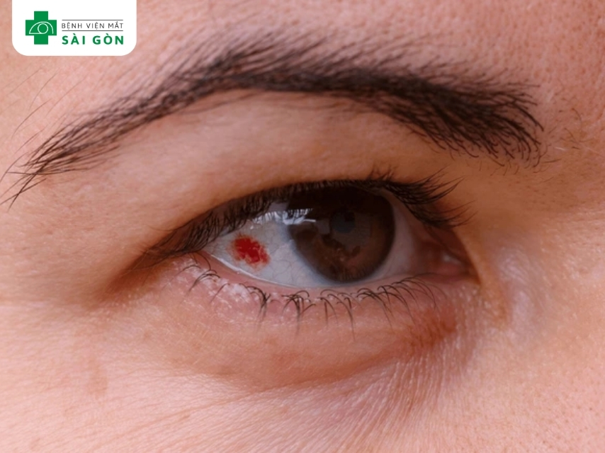 Xuất huyết dưới kết mạc gây ngứa khóe mắt