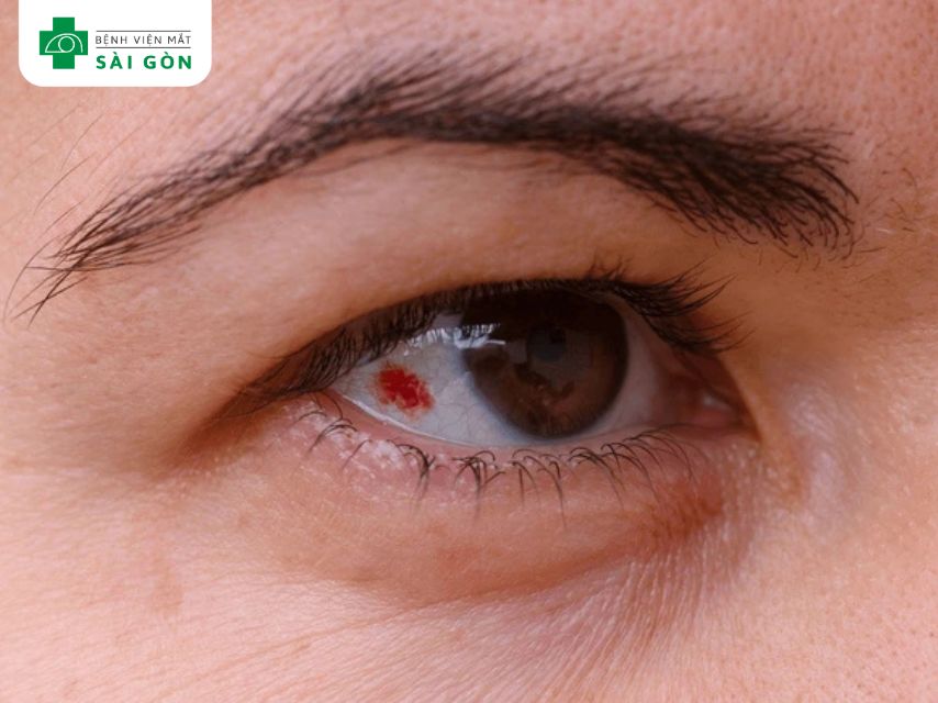 Xuất huyết kết mạc (subconjunctival hemorrhage)