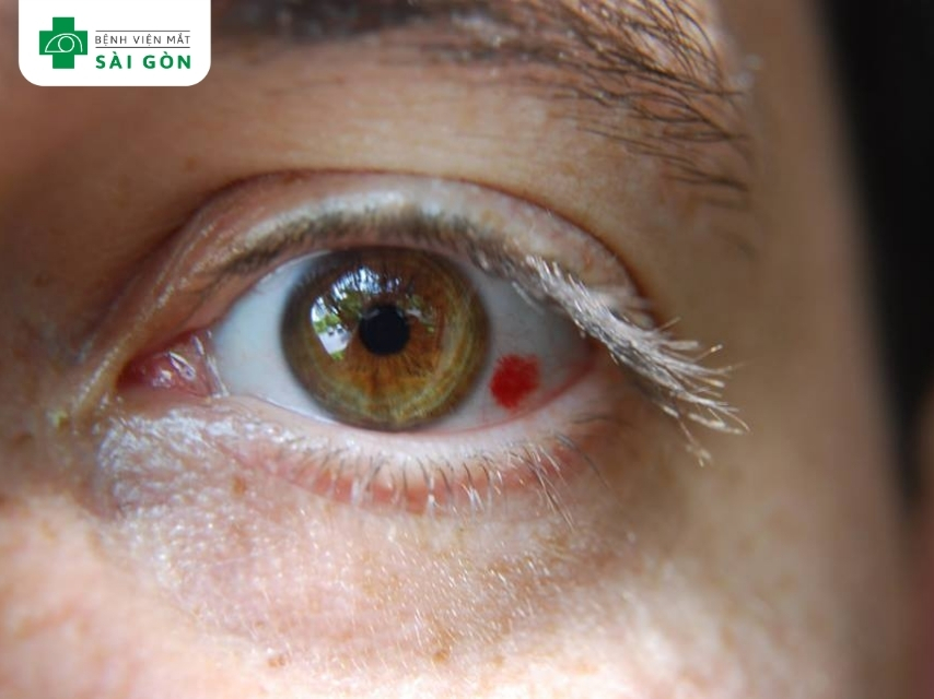 Cần đi khám bác sĩ nếu không tự tan từ 2 - 3 tuần