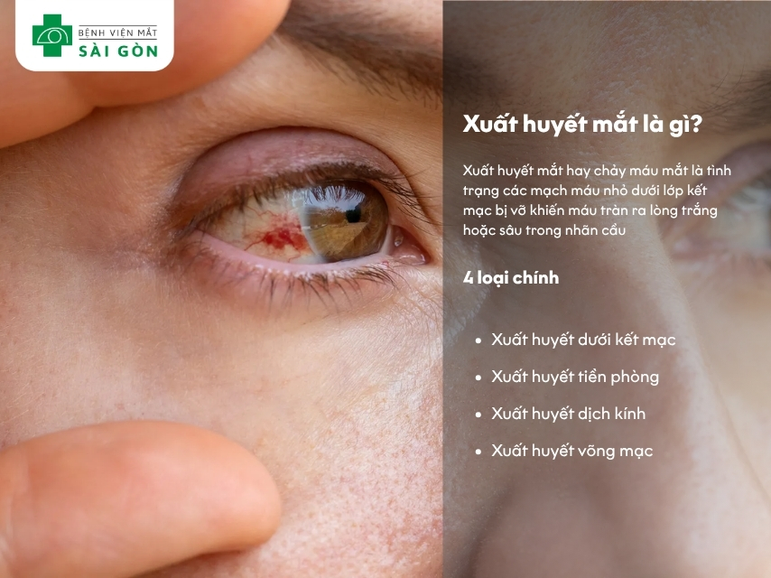 Xuất huyết mắt là gì