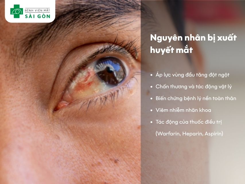 Nguyên nhân xuất huyết mắt