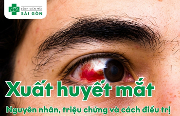 Tìm hiểu tổng quan về xuất huyết mắt