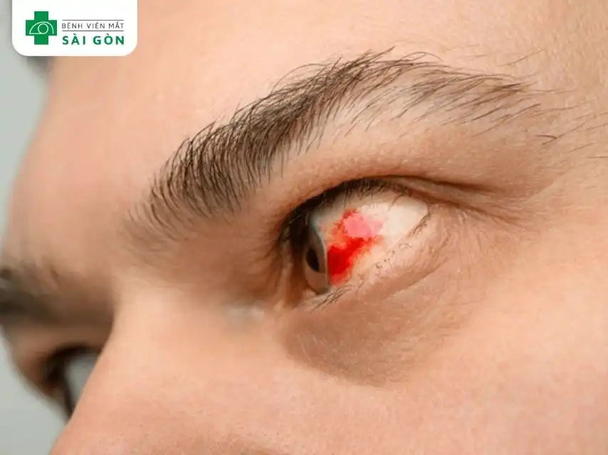 Chảy máu trong dịch kính gây vẩn đục dịch kính