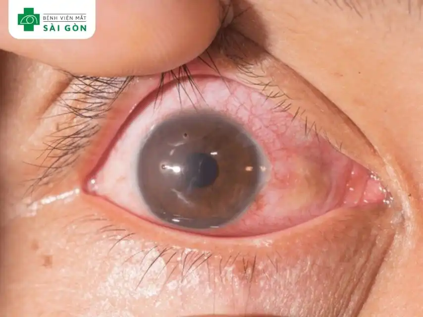 Xước giác mạc (Corneal Abrasion)