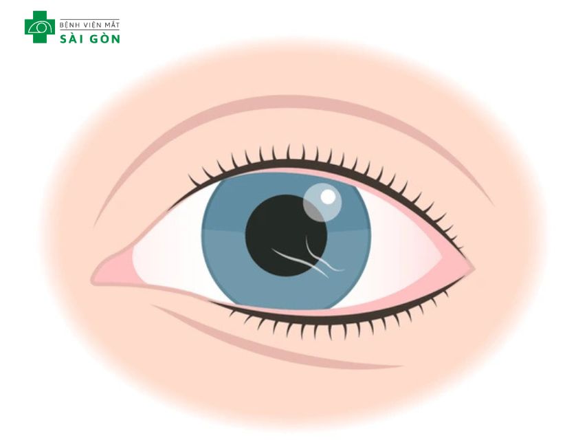 Xước kết mạc