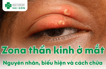 Zona thần kinh ở mắt