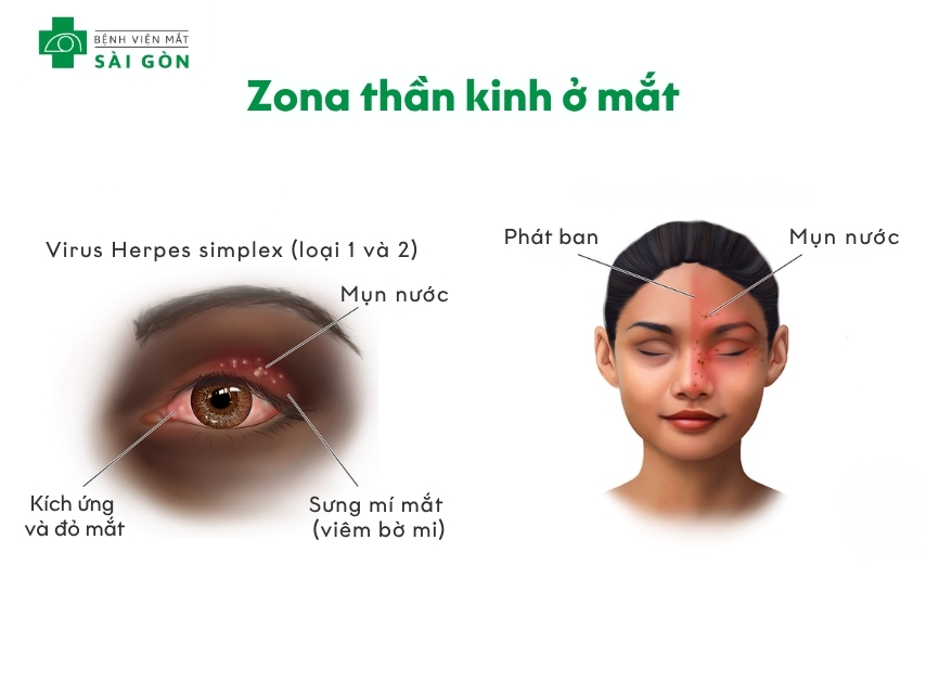 Zona thần kinh ở mắt gây tổn thương dây thần kinh mắt
